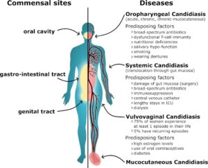 How fecal bifidobacteria inhibit pathogenic Candida albicans